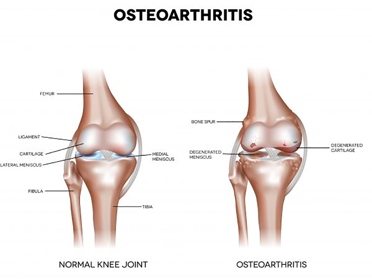 You are currently viewing Osteoarthritis
