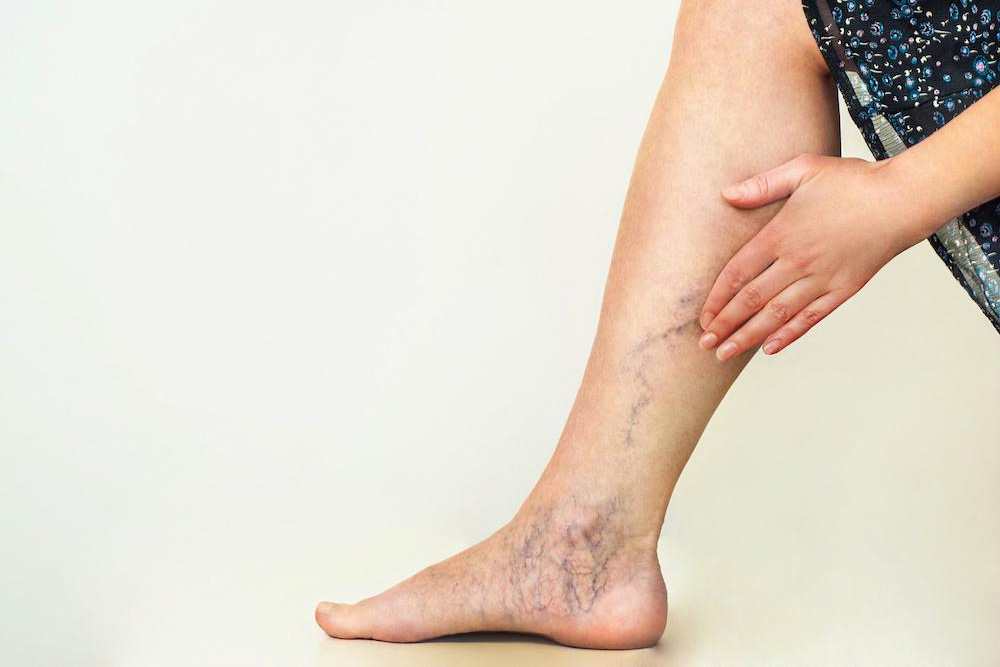 You are currently viewing Varicose Veins Treatment: Solutions for Healthier Legs